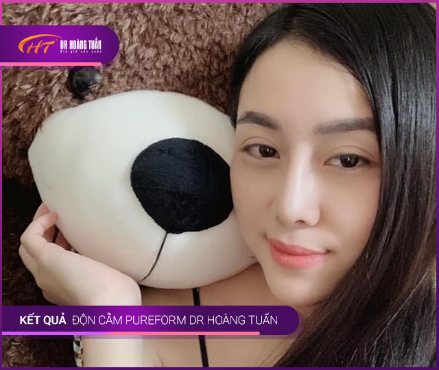 Kết quả độn cằm Pureform Thẩm mỹ Hoàng Tuấn